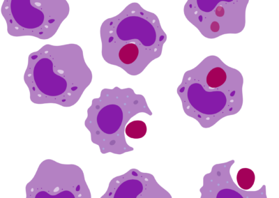 The MATCH trial – testing Macrophage cells   to treat liver cirrhosis