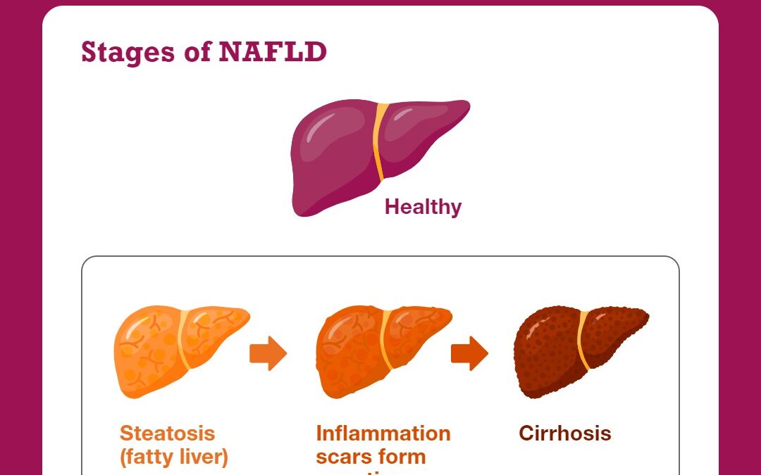 First ever Parliamentary Debate to address urgent issue of obesity-related liver disease in the UK