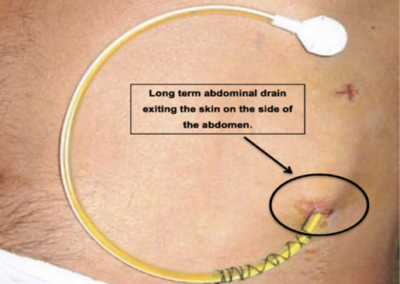 Improving quality of life for people with ascites: REDUCe 2 Study