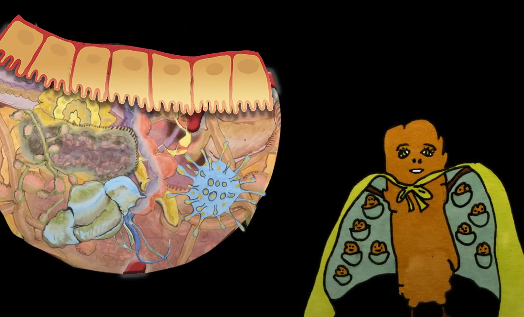 Attend The PROMISE Trial webinar: an innovative ‘Poo Transplant’ Trial to beat liver cirrhosis