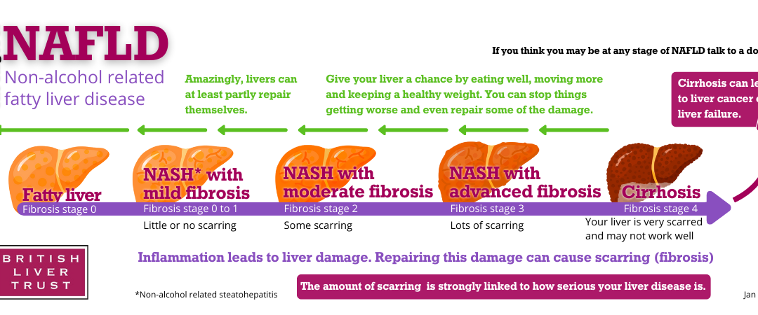 The British Liver Trust warns that an estimated four in five people who have the more advanced form of fatty liver disease are undiagnosed