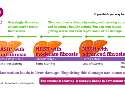 The British Liver Trust warns that an estimated four in five people who have the more advanced form of fatty liver disease are undiagnosed
