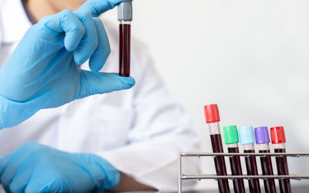 Researchers develop highly accurate test to identify NASH and liver fibrosis at an early stage
