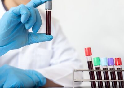 Researchers develop highly accurate test to identify NASH and liver fibrosis at an early stage