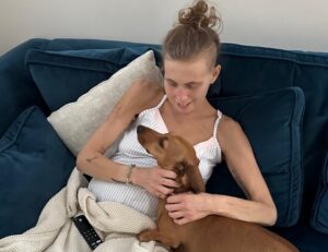 Stephanie on the sofa with her dachshund, pre transplant. There is muscle wastage on her arms and she generally appears unwell.